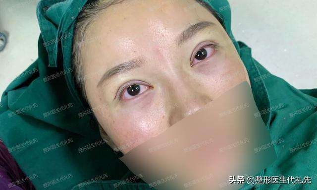 43岁来北京做全切开扇自然款双眼皮，朋友说眼睛看着年轻了10多岁