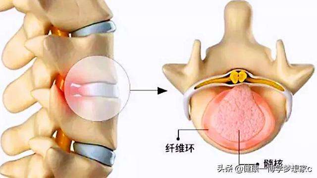 「科普」腰椎间盘突出，七个方法帮你缓解腰疼，腿麻，屁股疼