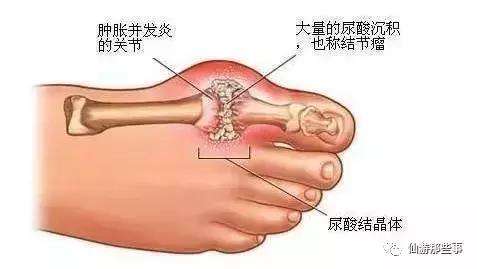 痛风最怕这种草，农村到处都有，这样吃再也不"痛"了！