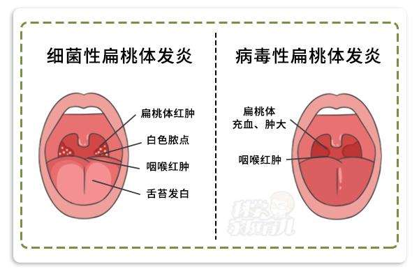 2招判断扁桃体发炎！除了吃药，这几件事在家就能做