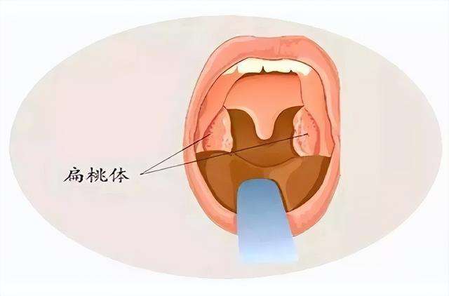 扁桃体发炎的危害到底有多大