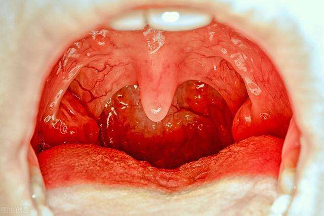 扁桃体发炎的危害到底有多大