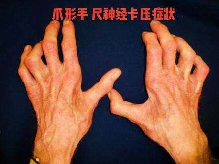 长期手麻不是小问题，要重视！医生给您详述易导致手麻的7种病因