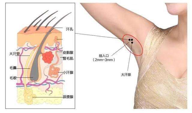 消除腋下异味，清新迎接夏天，腋臭如何安全有效祛除？