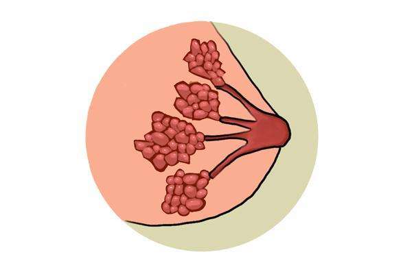 女子花近50万隆胸，不到一年查出乳腺癌，隆胸的四大风险，别忽视