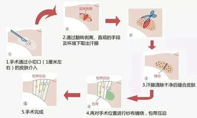 消除腋下异味，清新迎接夏天，腋臭如何安全有效祛除？