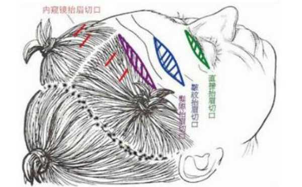 拉皮对身体有影响吗