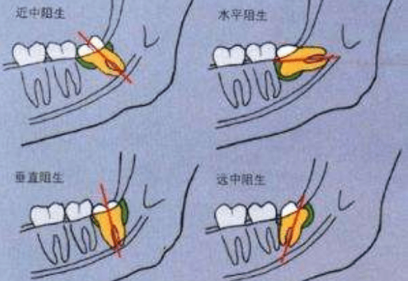 智齿牙长在哪个位置