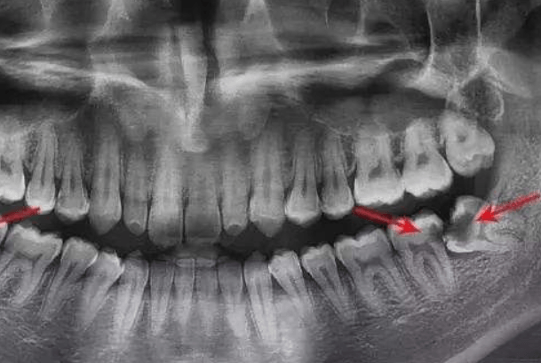 智齿牙长在哪个位置