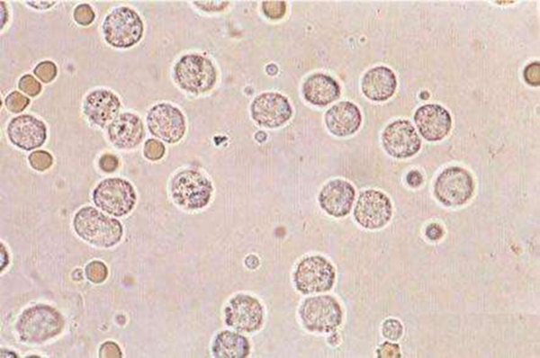 白细胞减少性白血病